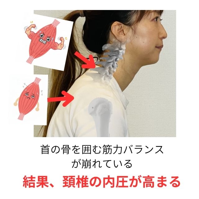 頸椎ヘルニア原因